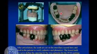 DENT 718 Partial denture attachments [upl. by Kleeman740]