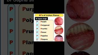 The 6Ps of Lichen Planus Explained shorts trendingshorts factsinhindi factshorts medicalfacts [upl. by Sidwell]