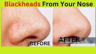 Remove Blackheads From Your Nose today [upl. by Yhtac]