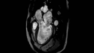 Aortic Regurgitation  Threechamber cine SSFP MR [upl. by Virgel328]