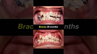 Braces 26 months duration Severely crooked teeth braces orthodontist bracesoff dentist [upl. by Saideman]