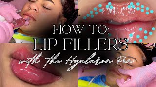 How to do Lip Filler w the Hyaluron Pen  Hyaluron Pen Tutorial  hyaluronpen hyaluronicacid [upl. by Aneladdam436]