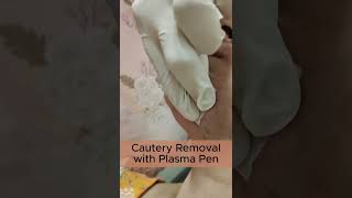 Cautery Removal with Plasma Pen [upl. by Nbi]