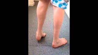 Charcot Marie Tooth Disease before Orthotics [upl. by Eidak802]