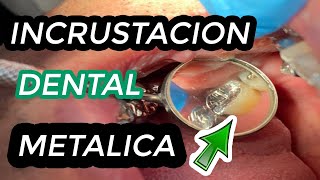 COMO se hacen las INCRUSTACIONES DENTALES METALICAS  Incrustación dental  Restauración de muela 🦷 [upl. by Nywnorb]