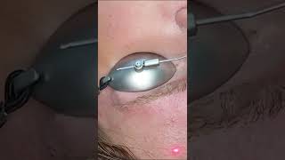 Pico Derma 4 laser tatoeage en permanente makeup verwijderen Noord Holland [upl. by Critta]