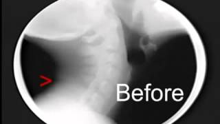 Neck Treatment under Motion X ray with the Arthrostim [upl. by Anwahsat289]