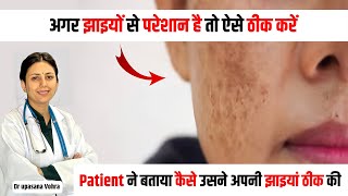 Melasma Treatment Permanently  Jhaiya khatam karne ka tareeka 😳 100 Results  Dr Upasana Vohra [upl. by Naimaj]