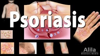 Psoriasis Types Symptoms Causes Pathology and Treatment Animation [upl. by Hylan]