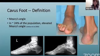 CavoVarus Feet Reconstruction [upl. by Winer]