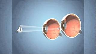 Monovision for Presbyopia [upl. by Huntlee]