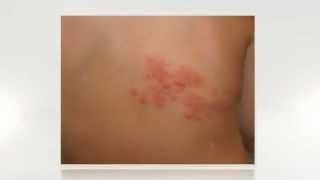 How to treat shingles over the counter and how to cure shingles in 3 days [upl. by Symer839]