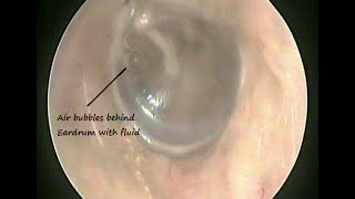 Otoendoscopy  Fluid behind Eardrum  Serous Otitis media  Glue ear  due to cold amp allergy [upl. by Devan8]