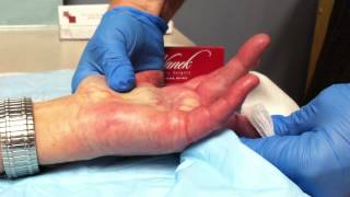 Paul Vanek MD  Xiaflex Crooked Finger Treatment 7 [upl. by Cointon439]