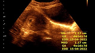 Anembryonic pregnancy with abortion in progress [upl. by Gretal]