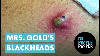 Mrs Golds Back Blackhead Extraction Session  Addressing the Inflamed One [upl. by Fulvia]