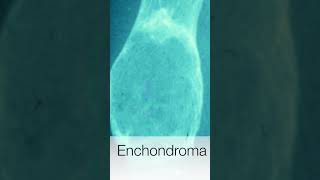 Enchondroma  Pathology shorts [upl. by Troxell856]