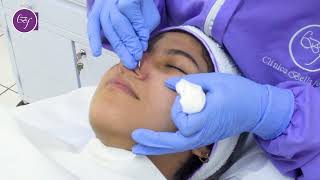 Limpieza Facial  Punta de Diamante 🤩 Clínica Bellaforma [upl. by Oratnek]