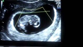 10 weeks 2 days ultrasound [upl. by Segal]