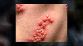 Antiviral Drugs For Shingles Rashes [upl. by Schechinger467]