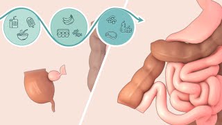 Ileocolic resection for Crohns disease  Patient Education  TVASurg [upl. by Anirdua119]