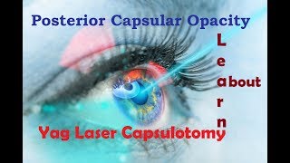 What is Posterior Capsular Opacity amp Yag Laser Capsulotomy Hindi [upl. by Nwahsd498]