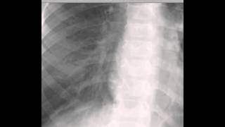 Pediatric Chest Xray Pneumonia DISCUSSION by Radiologist [upl. by Atinas432]