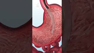 Gastric Balloon in Turkey shorts gastricballoon [upl. by Robson35]