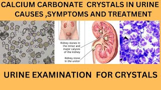 CALCIUM CARBONATE CRYSTALS IN URINECAUSES SYMPTOMS TREATMENT OF CALCIUM CARBONATE STONES [upl. by Mahgirb765]