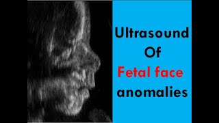 Ultrasound of fetal face anomalies [upl. by Kaslik]