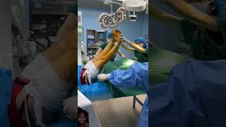 Operation theatre lithotomy positionMBBS surgery sohorts shortsyoutube operationpolo [upl. by Ahselyt]