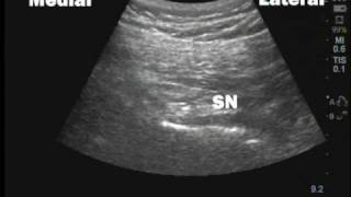 Unintentional sciatic nerve block following pudendal nerve block [upl. by Homerus74]