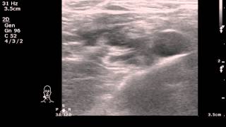 29M suffered from shoulder dislocation Treated with echoguided inter scalene block [upl. by Assilac70]