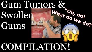 Braces causing gum tumorsswollen gums compilation [upl. by Rubin]