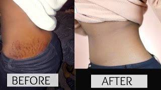 HOW TO GET RID OF STRETCH MARKS amp SCARS FAST [upl. by Avruch31]