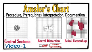 Amslers Chart Procedure Prerequisites Scotoma Interpretation Documention Video2 [upl. by Irving]