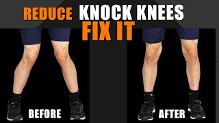 Best Exercises to Correct Knock Knees in Telugu  How to fix Knock Knees [upl. by Wallace716]