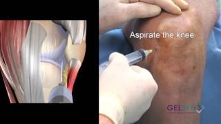 Inferior Medial Flexed Knee GELSYN3 [upl. by Nichols]