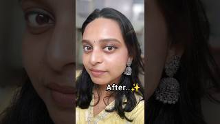 Skin Transformation Acne to Clear skin shorts skincare beauty [upl. by Nnyleimaj]