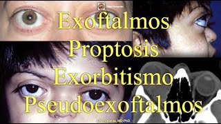 Proptosis Exoftalmos Exorbitismo y Pseudoexoftalmos [upl. by Ycrem]