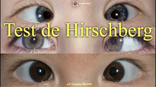 Test de Hirschberg [upl. by Neeruan]