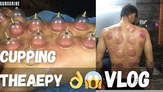 Cupping therapy benefits  Body massage [upl. by Filbert]