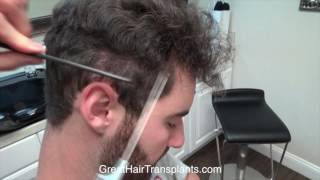 Dr Brett Bolton FUE  Artas Correction Patient Casey Full Video [upl. by Branen703]