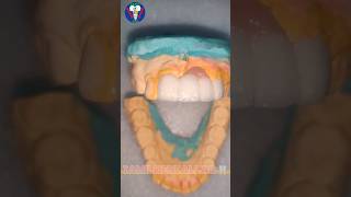 Ceramic Teeth  Upper Anterior  Maxillary Insicor  PFM  Tamil Dental Lab  tamildentist shorts🦷 [upl. by Uyerta]