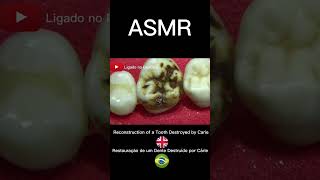 Incrível Restauração de um Dente DESTRUÍDO por Cárie  Endodontia [upl. by Enaira864]