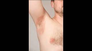 Armpit Yeast Infection healthcare health [upl. by Helse]