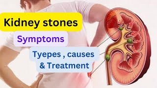 Everything you need to know about kidney stone [upl. by Rraval754]