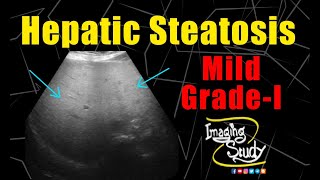 Mild Hepatic Steatosis  GradeI Fatty Liver  Ultrasound  Case 226 [upl. by Nosnaj]