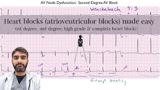 AV blocksHeart blocks Made Easy [upl. by Leahcin646]