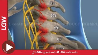 Cervical Radio Frequency Ablation animated surgery recreation [upl. by Sarine]